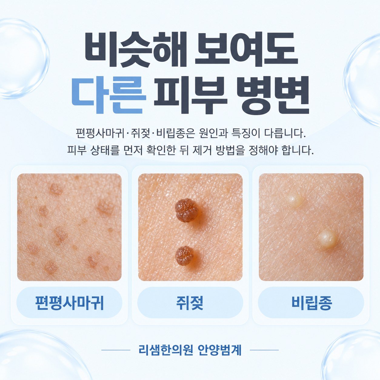 편평사마귀, 쥐젖, 비립종의 생김새를 나란히 비교한 그림